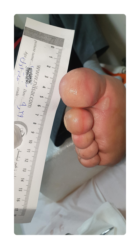 Diabetic foot blister (1)