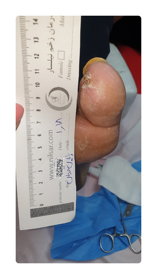 Diabetic foot blister (3)