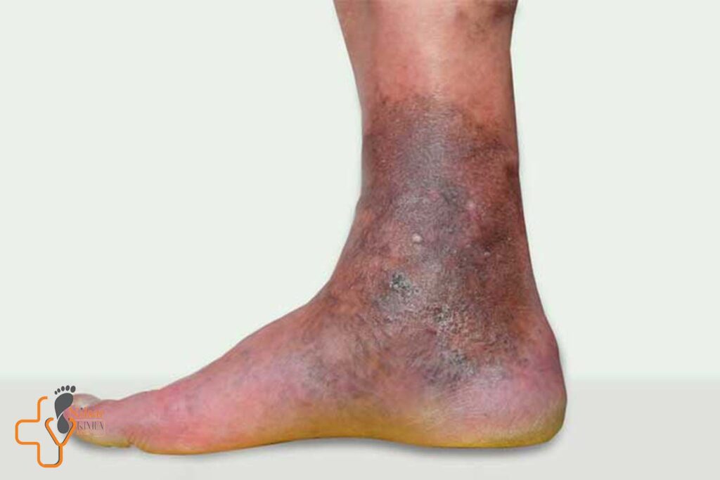 روش نوین درمان زخم پای وریدی