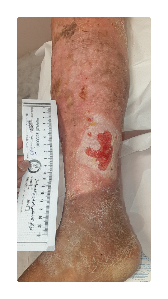 treatment of varicose veins in a diabetic patient (1)