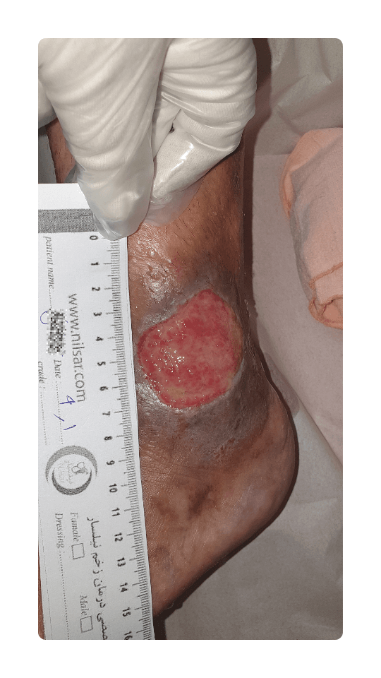 venous treatment due to varicose veins (2)