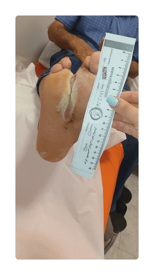 wound treatment for bone infection (2)