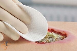 دبریدمان زخم سوختگی