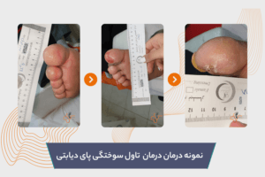 نمونه درمان تاول پای دیابتی
