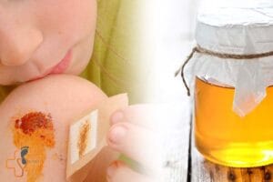 درمان زخم سوختگی با عسل