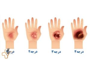 درمان زخم سوختگی درجه 4