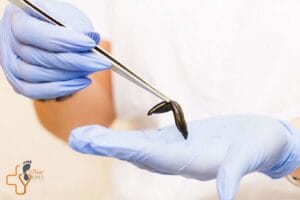 زالو درمانی برای زخم پای دیابتی