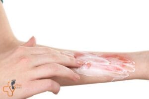 سریعترین درمان سوختگی عمیق