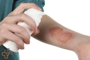 شست و شوی زخم سوختگی