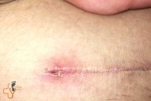 عفونت زخم جراحی چیست ؟