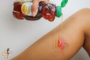 نمونه درمان زخم با عسل