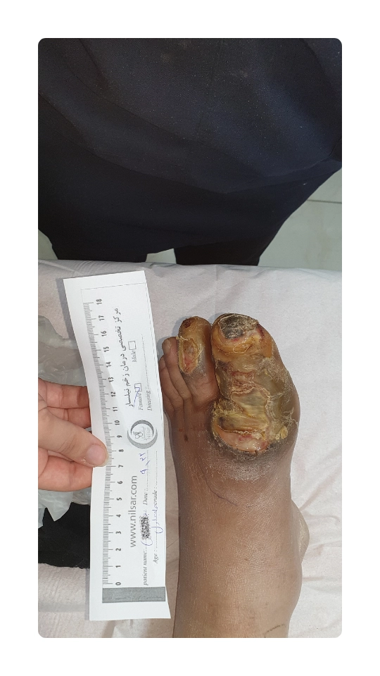 An example of treatment of neuropathy wound 1
