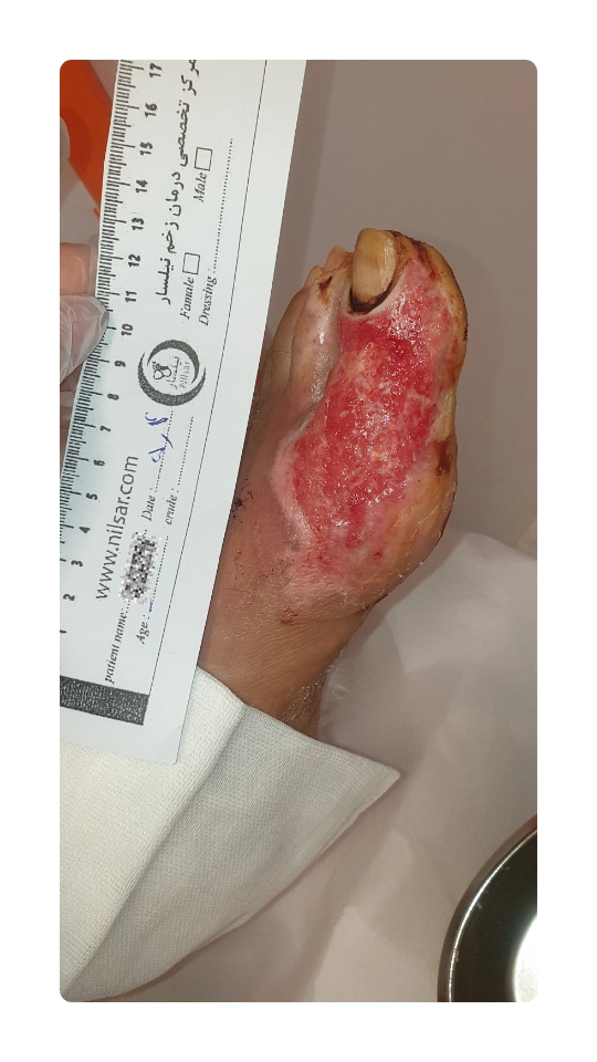 ex burn wounde diabetic 2