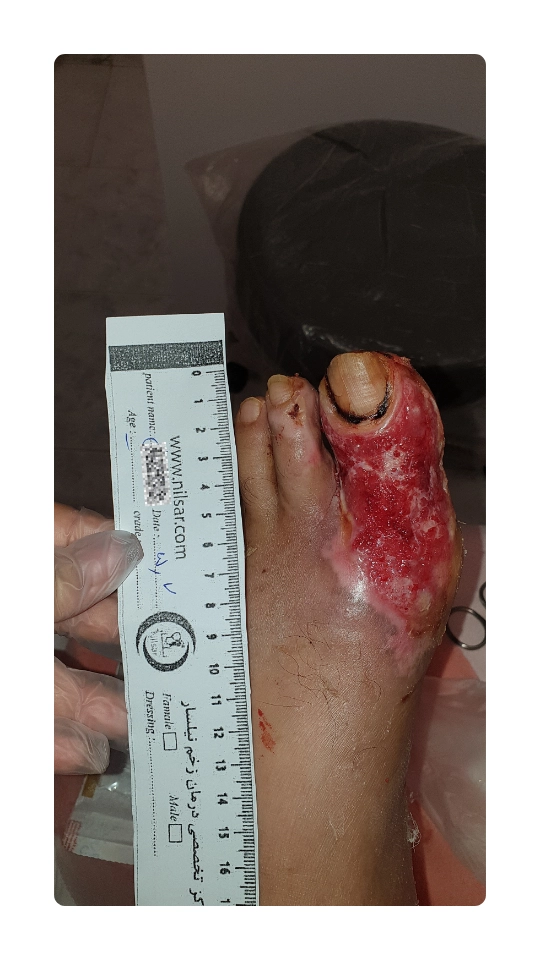 ex burn wounde diabetic 3