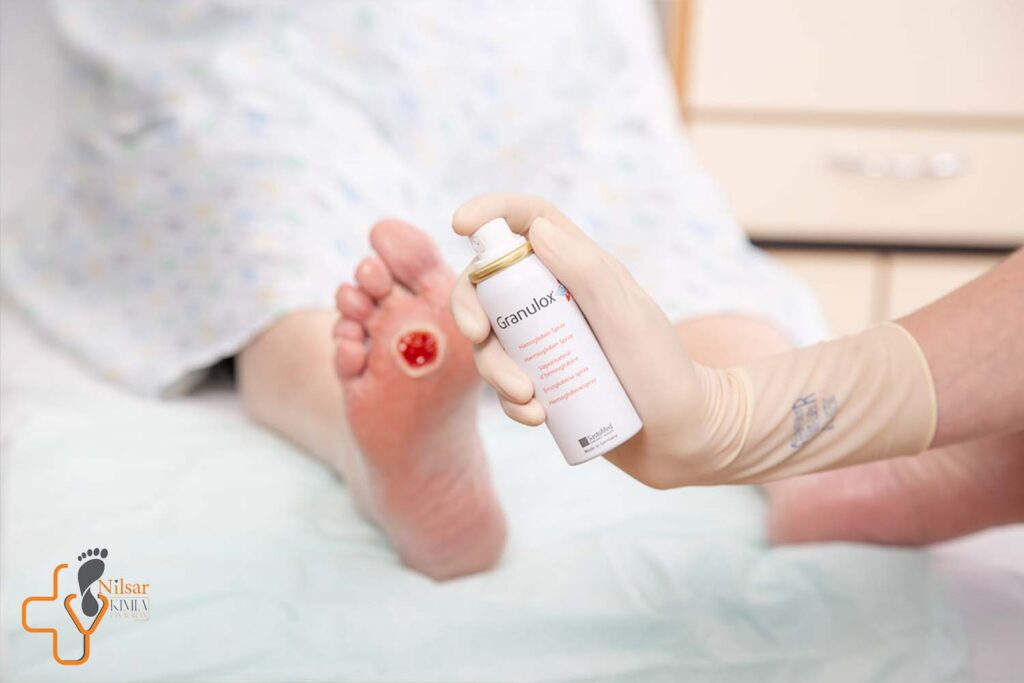 اهمیت پمادها در درمان زخم پای دیابتی