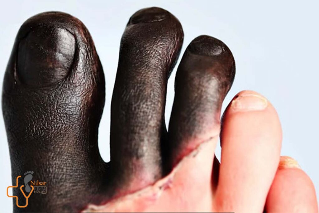 بهترین روش درمان سیاه شدن انگشت پا دیابتی چیست؟