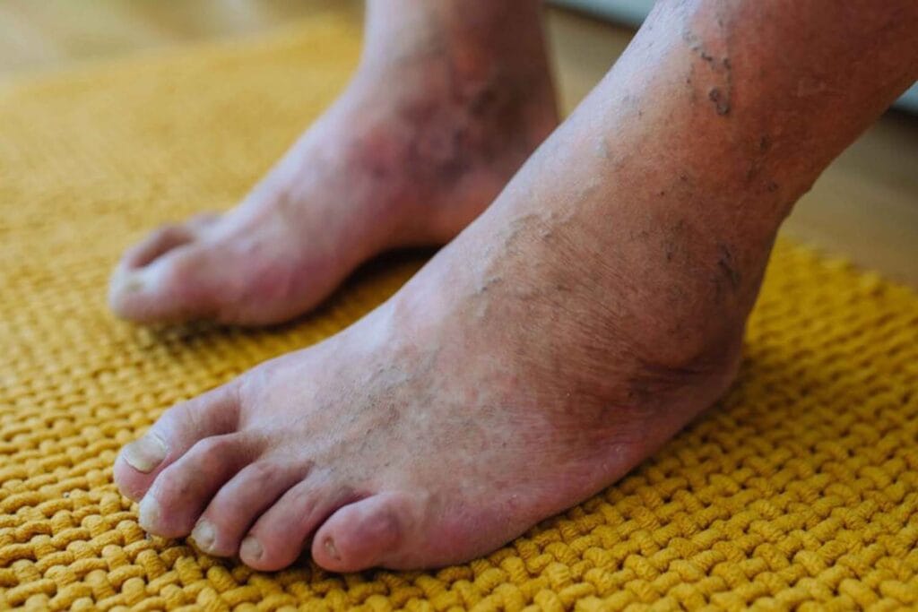 بازسازی بافت‌های آسیب‌دیده در زخم‌های دیابتی