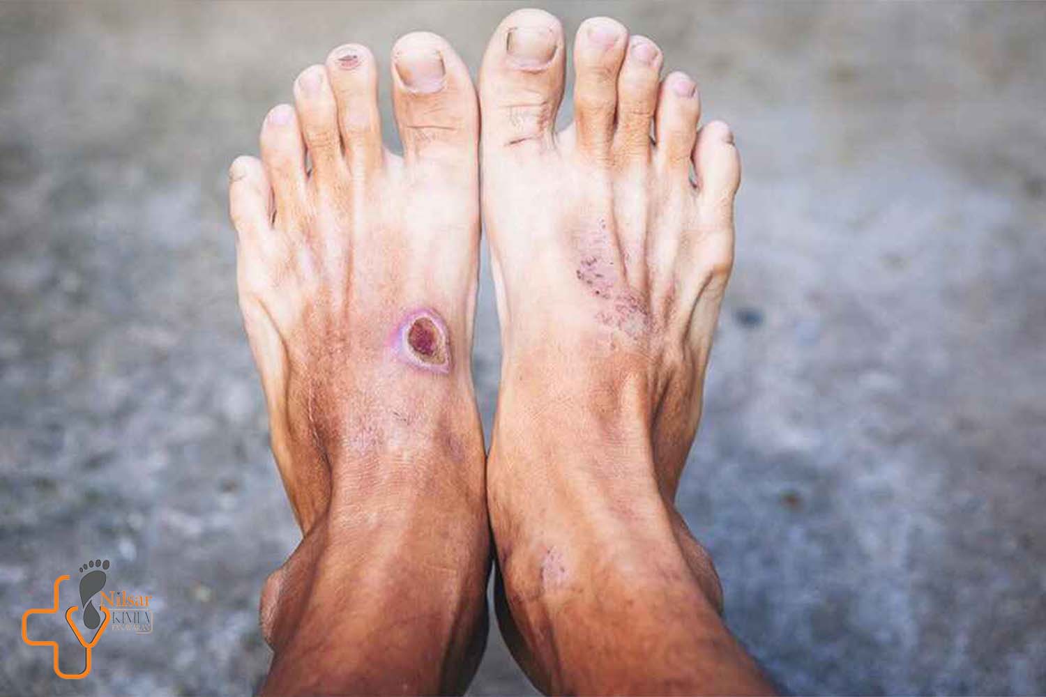 جراحی‌های ترمیمی در درمان زخم‌های دیابتی