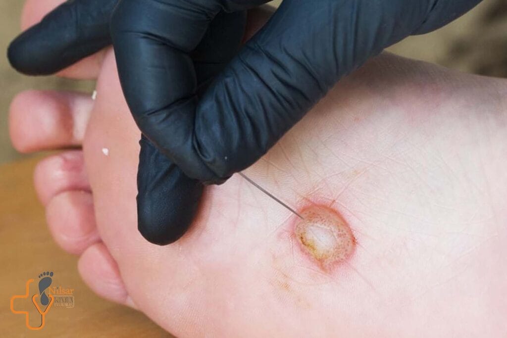 مقایسه درمان‌های سنتی و مدرن در درمان زخم دیابت