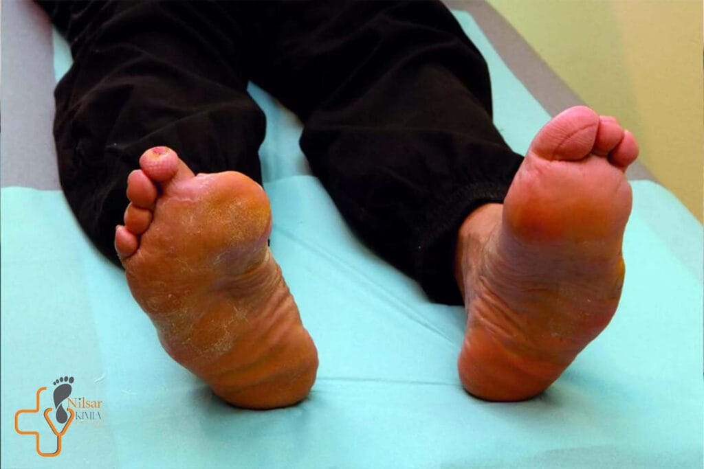 پیشگیری از زخم‌های دیابتی