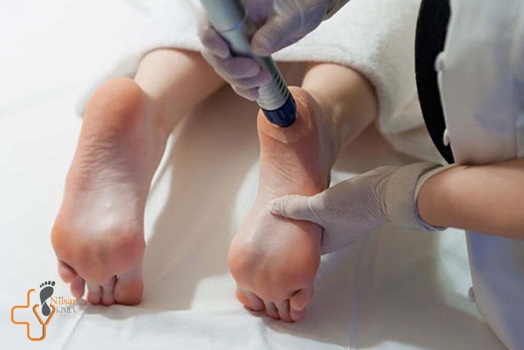 پیشگیری از عفونت‌های زخم دیابتی و روش‌های درمانی موثر