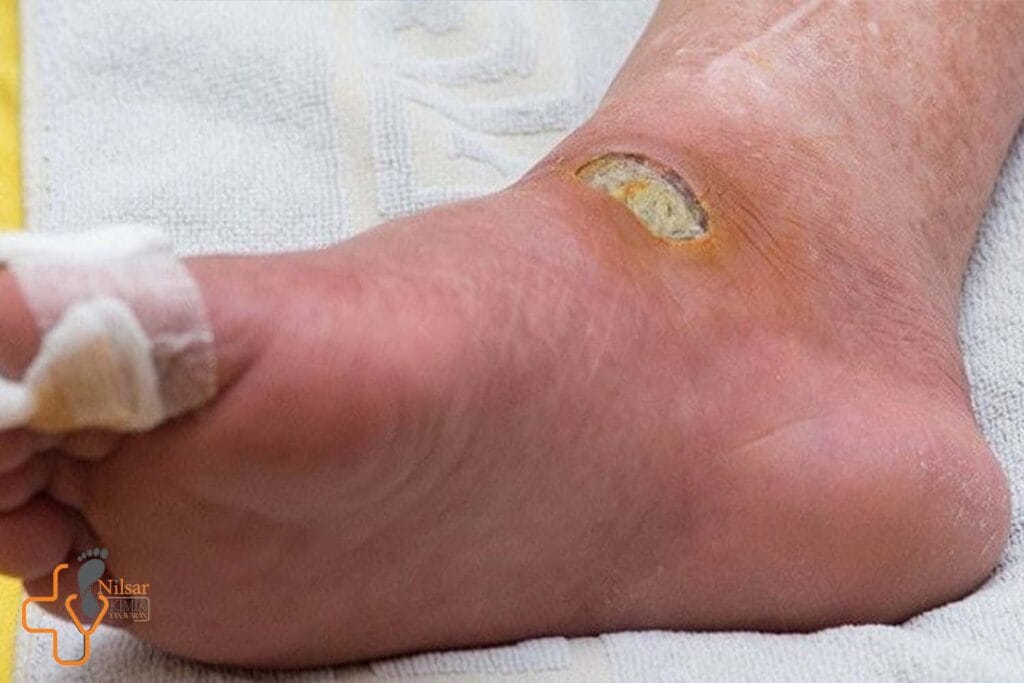 پایان دادن به زخم‌های دیابتی با درمان‌های ترکیبی