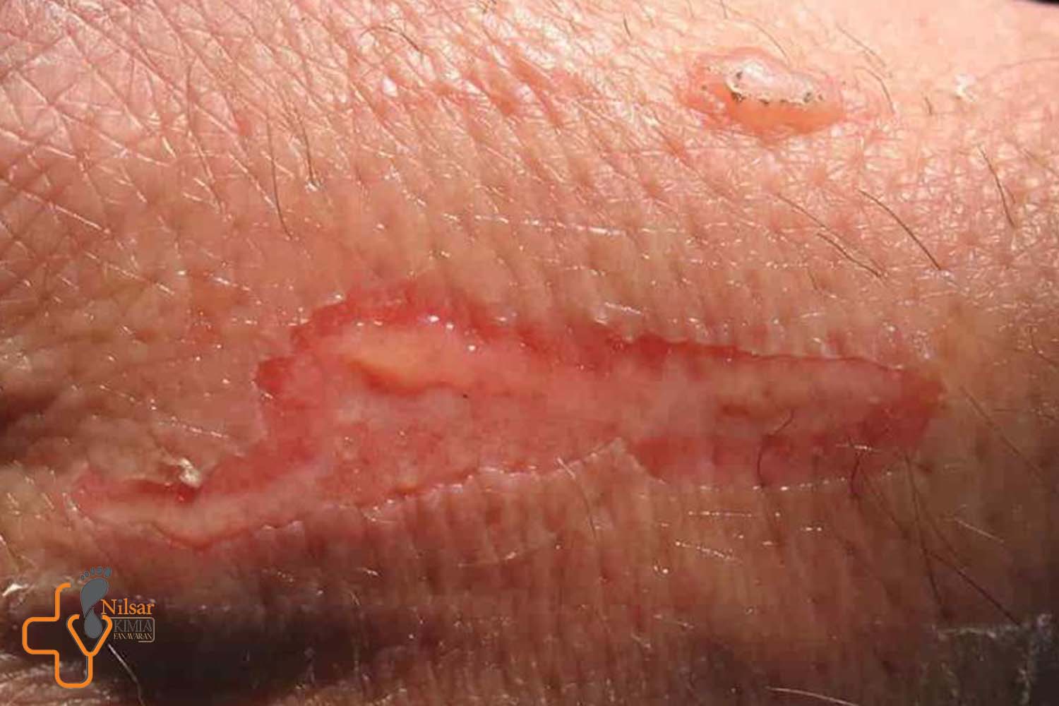 بررسی نانوپانسمان‌ها در تسریع روند بهبود زخم‌های سوختگی