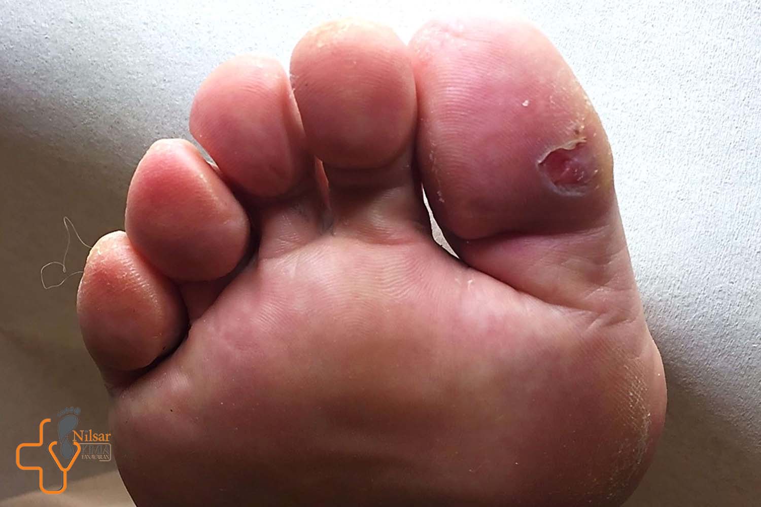 چطور درد مربوط به زخم دیابت را کاهش دهم؟