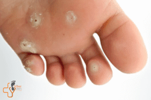 طول عمر بیماران نوروپاتی