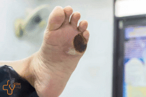 سرم شستشوی زخم دیابتی