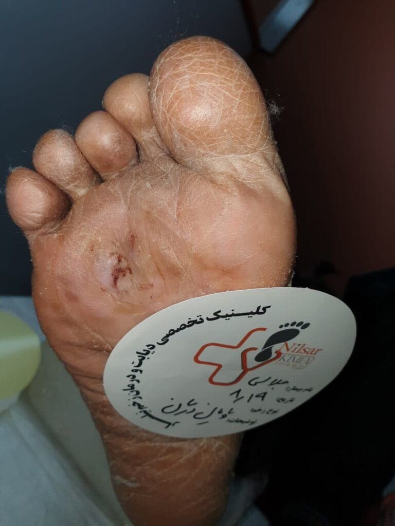 زخم کف پا