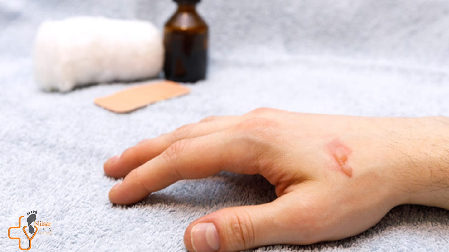 راهنمای کامل انواع سوختگی پوست