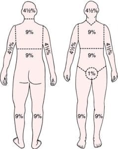 ارزیابی سوختگی با استفاده از چارت قانون ۹
