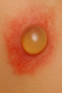 «تصویر سوختگی درجه دو با تاول شفاف – نشانههای اولیه آسیب پوستی»